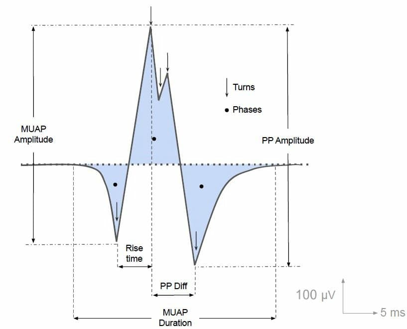 MUAP waveform, from A morphology-based feature set for automated Amyotrophic Lateral Sclerosis diagnosis on surface electromyography by Antunes et al. 2023