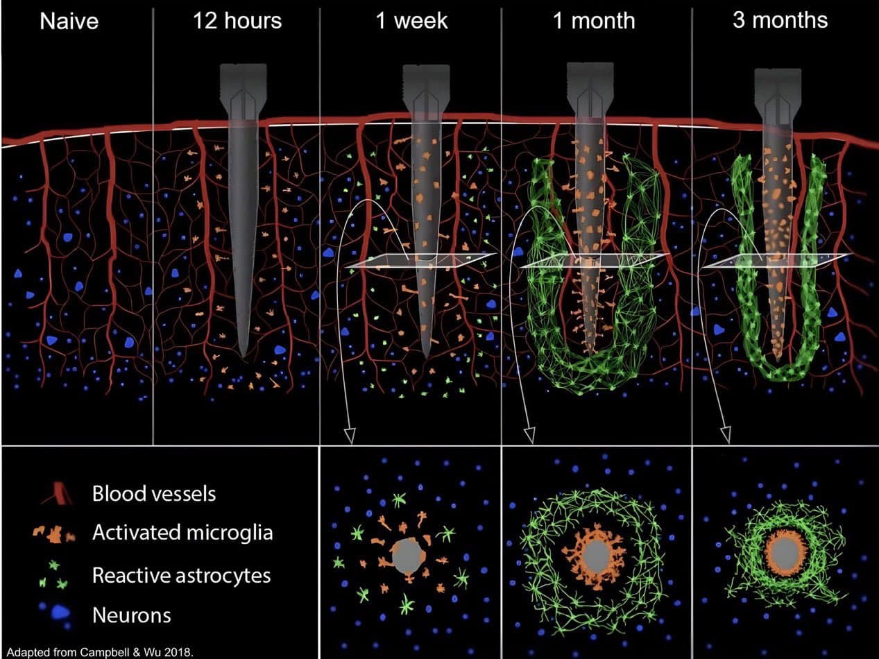 Glial scarring and encapsulation around a chronically implanted electrode shank