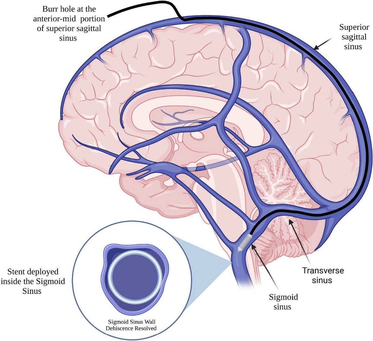 Superior Saggital Sinus
